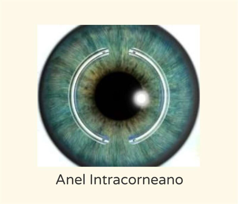 Anel intracorneano - Instituto de Olhos de Florianópolis