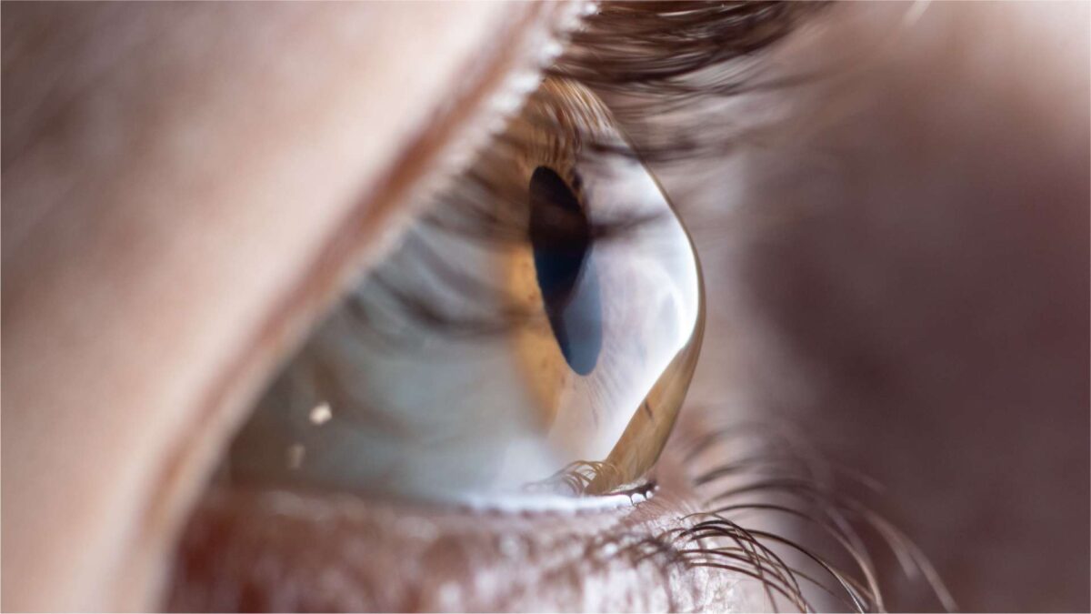 ceratocone - Instituto de Olhos de Florianópolis - Oftalmologista Florianópolis