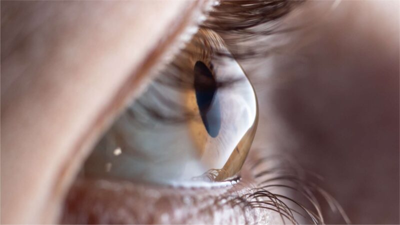 ceratocone - Instituto de Olhos de Florianópolis - Oftalmologista Florianópolis