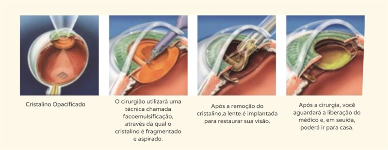 cirurgia de catarata - Instituto de Olhos de Florianópolis