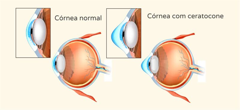 Córnea com ceratocone - Instituto de olhos de Florianópolis