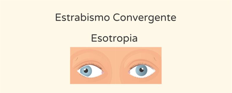 Estrabismo convergente - instituto de olhos de florianópolis