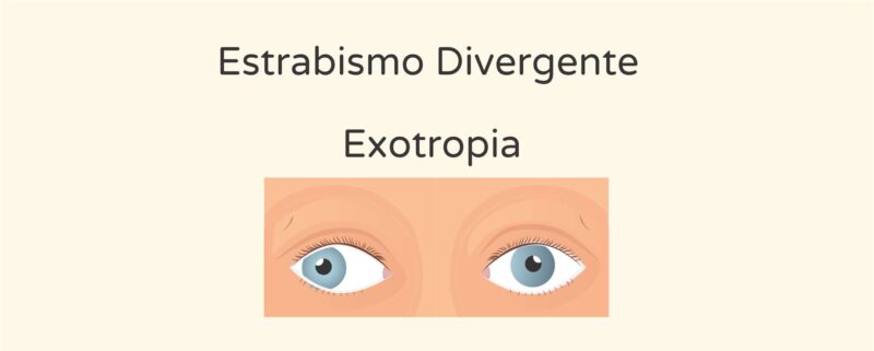 Estrabismo divergente - instituto de olhos de florianopolis