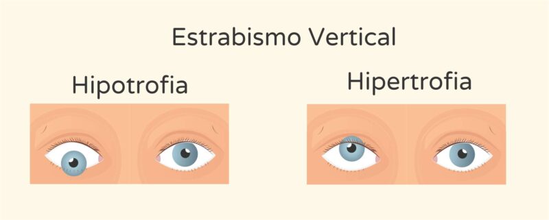 estrabismo vertical - Instituto de Olhos de Florianópolis