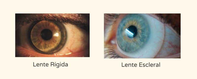 Lentes rígidas e lentes esclerais - Instituto de Olhos de Florianópolis