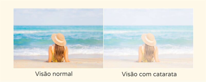 Sintomas catarata - Instituto de Olhos Florianópolis