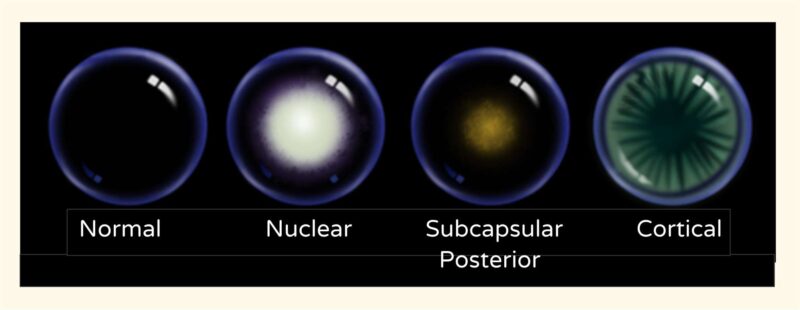 tipos de catarata - Instituto de olhos de Florianópolis