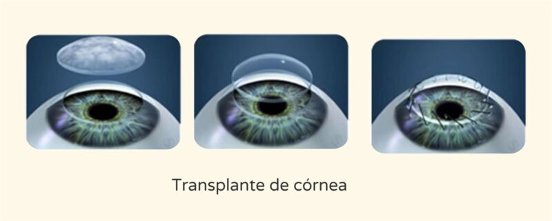 Transplante de Córnea - Instituto de Olhos de Florianópolis