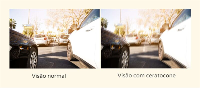 Visão com ceratocone - Instituto de Olhos de Florianópolis
